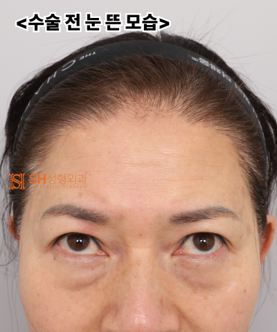 Kelopak mata kendur usia 51 tahun, mengapa diatasi dengan Endotine Forehead Lift daripada incisional double eyelid? | Ka