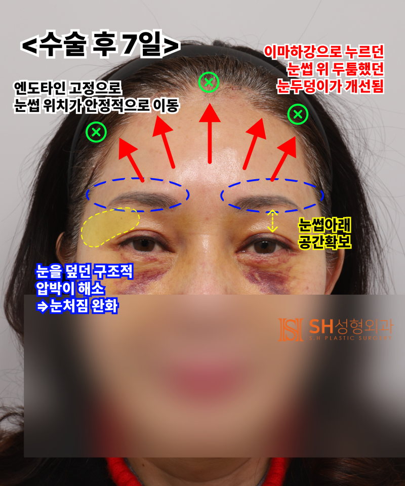 Kelopak mata kendur usia 51 tahun, mengapa diatasi dengan Endotine Forehead Lift daripada incisional double eyelid? | Ka
