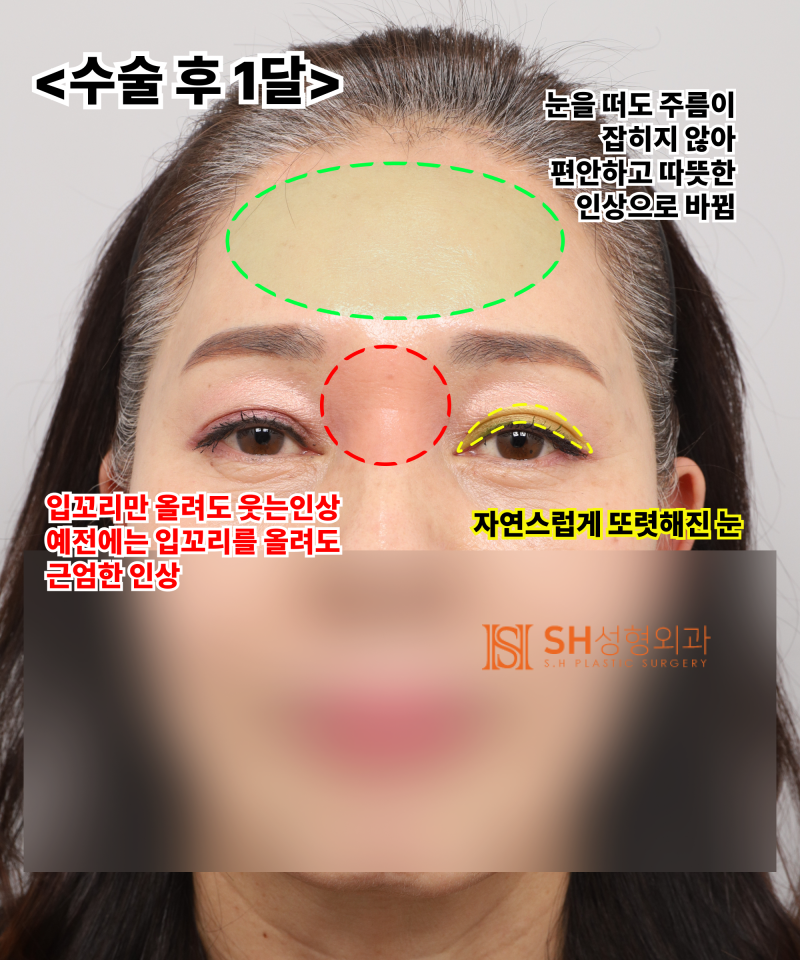 Kelopak mata kendur usia 51 tahun, mengapa diatasi dengan Endotine Forehead Lift daripada incisional double eyelid? | Ka