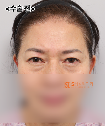 Kelopak mata kendur usia 51 tahun, mengapa diatasi dengan Endotine Forehead Lift daripada incisional double eyelid? | Kasus operasi gabungan sub-brow lift dan blepharoplasty bawah di SH Plastic Surgery