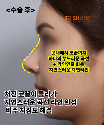 Meskipun menginginkan pengecilan cuping hidung, hidung ini seharusnya tidak melakukannya! Alasan mengapa ujung hidung le