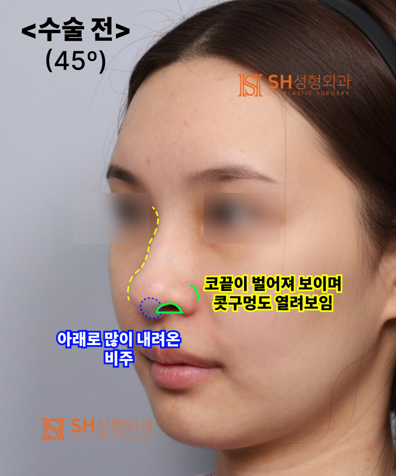 Nose that wanted alar reduction but shouldn't have! Why the nasal tip came first | SH Plastic Surgery 사진 7