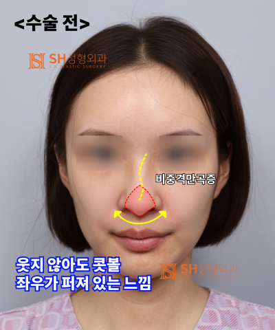 Nose that wanted alar reduction but shouldn't have! Why the nasal tip came first | SH Plastic Surgery 사진 8
