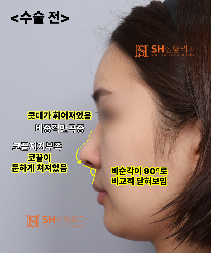 Nose that wanted alar reduction but shouldn't have! Why the nasal tip came first | SH Plastic Surgery 사진 6