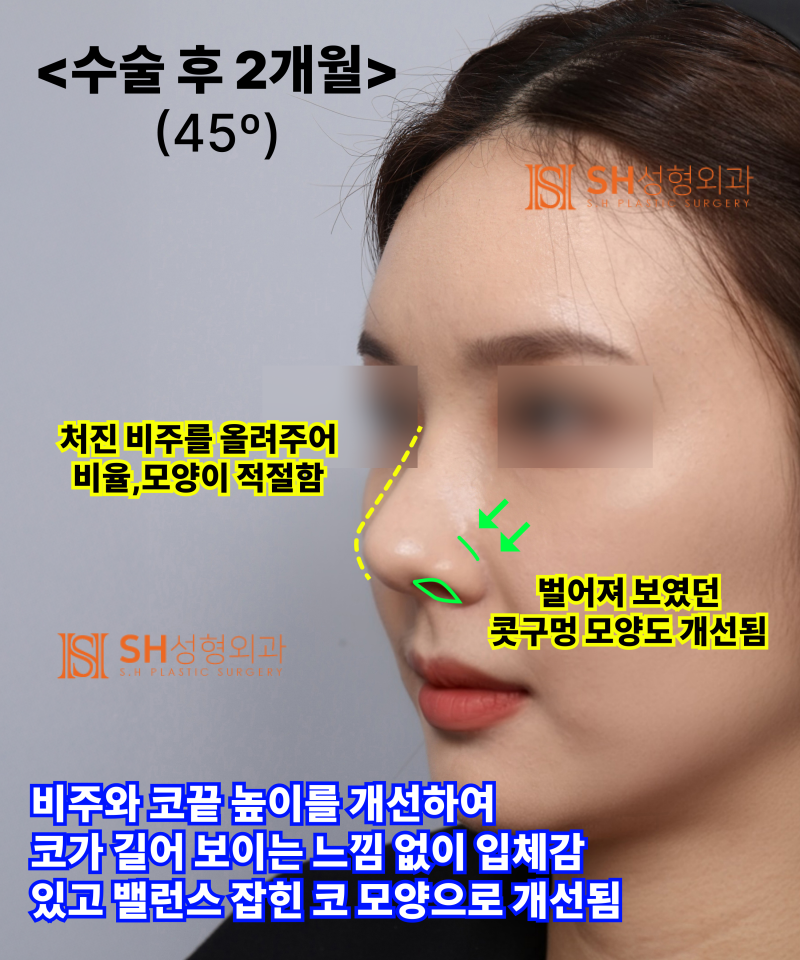 Nose that wanted alar reduction but shouldn't have! Why the nasal tip came first | SH Plastic Surgery 사진 15