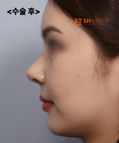 Nose that wanted alar reduction but shouldn't have! Why the nasal tip came first | SH Plastic Surgery 사진 33