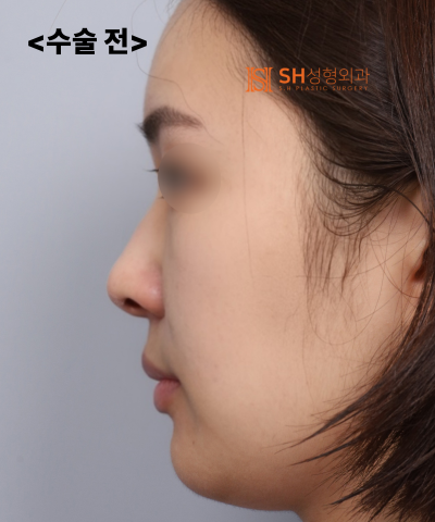 Nose that wanted alar reduction but shouldn't have! Why the nasal tip came first | SH Plastic Surgery 사진 32