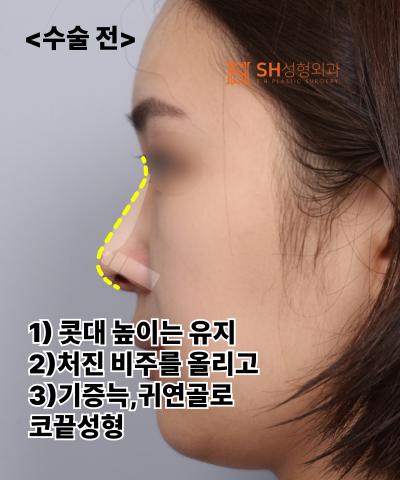 Nose that wanted alar reduction but shouldn't have! Why the nasal tip came first | SH Plastic Surgery 사진 11