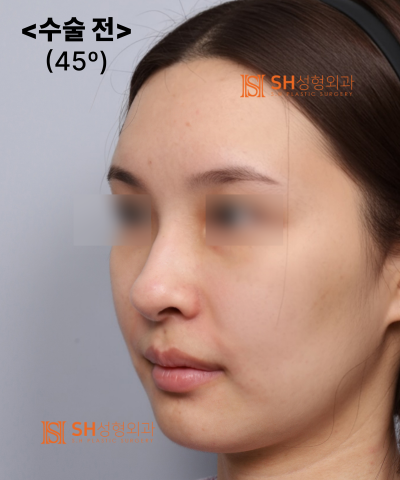 Nose that wanted alar reduction but shouldn't have! Why the nasal tip came first | SH Plastic Surgery 사진 34
