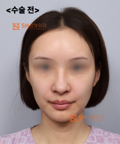 Nose that wanted alar reduction but shouldn't have! Why the nasal tip came first | SH Plastic Surgery 사진 30