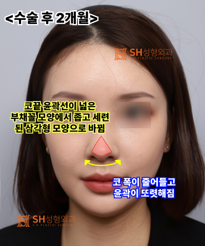 Nose that wanted alar reduction but shouldn't have! Why the nasal tip came first | SH Plastic Surgery 사진 25