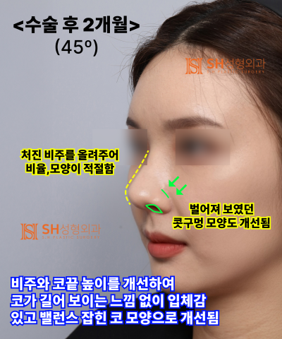 Nose that wanted alar reduction but shouldn't have! Why the nasal tip came first | SH Plastic Surgery 사진 21