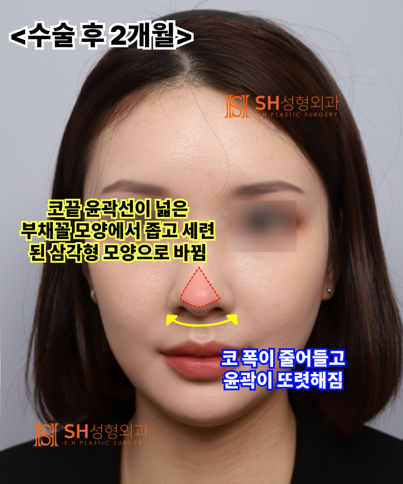 Nose that wanted alar reduction but shouldn't have! Why the nasal tip came first | SH Plastic Surgery 사진 13