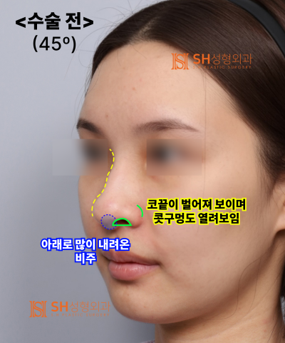 Nose that wanted alar reduction but shouldn't have! Why the nasal tip came first | SH Plastic Surgery 사진 20