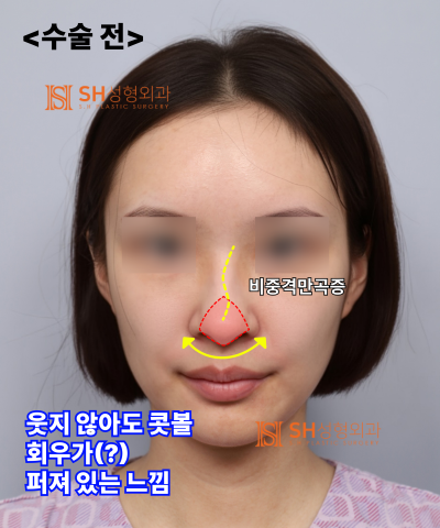 Nose that wanted alar reduction but shouldn't have! Why the nasal tip came first | SH Plastic Surgery 사진 22
