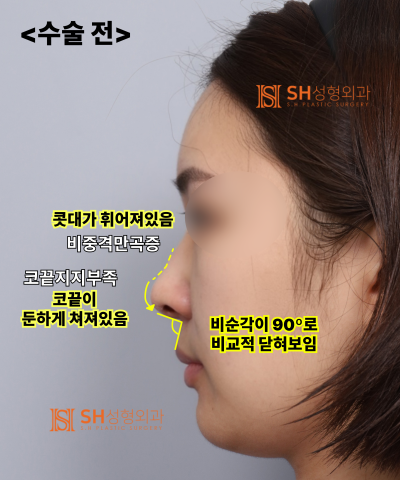 Nose that wanted alar reduction but shouldn't have! Why the nasal tip came first | SH Plastic Surgery 사진 18