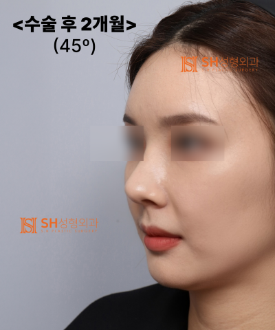 Nose that wanted alar reduction but shouldn't have! Why the nasal tip came first | SH Plastic Surgery 사진 35