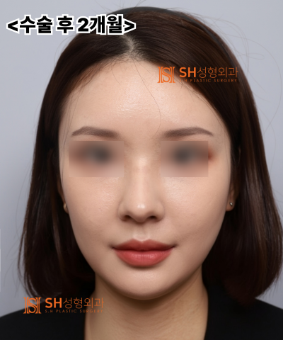 Nose that wanted alar reduction but shouldn't have! Why the nasal tip came first | SH Plastic Surgery 사진 31