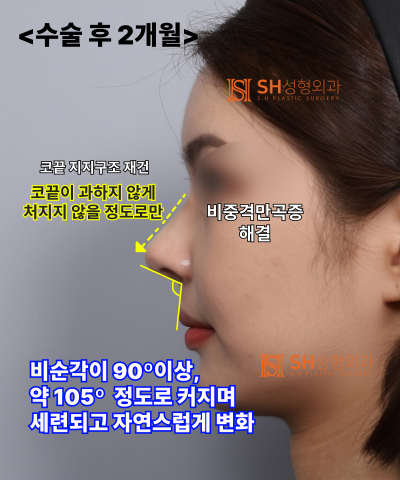 Nose that wanted alar reduction but shouldn't have! Why the nasal tip came first | SH Plastic Surgery 사진 26