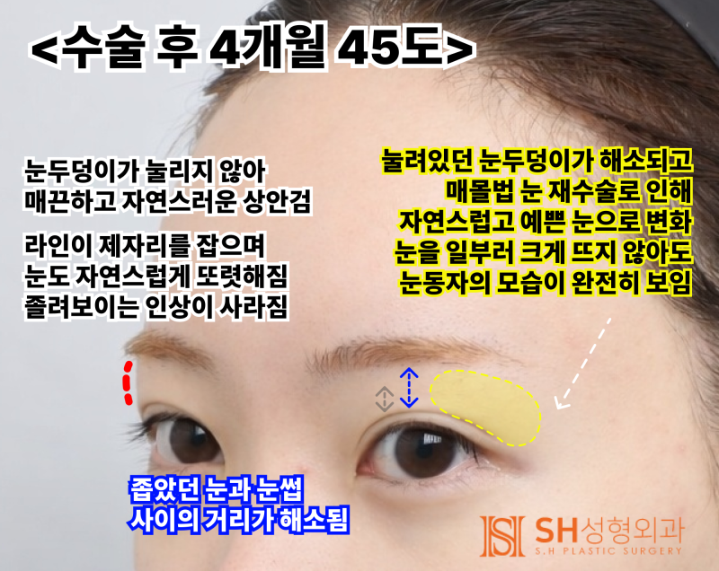 Endoscopic Forehead Lift and Revision Buried Suture Double Eyelid Surgery, Sub-brow Lift: Restoring Eye Structure at SH