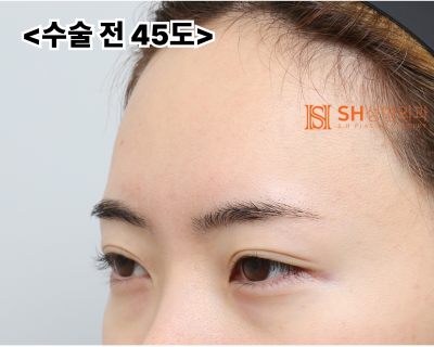 Endoscopic Forehead Lift and Revision Buried Suture Double Eyelid Surgery, Sub-brow Lift: Restoring Eye Structure at SH