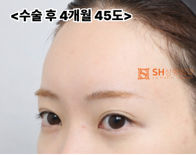 Endoscopic Forehead Lift and Revision Buried Suture Double Eyelid Surgery, Sub-brow Lift: Restoring Eye Structure at SH