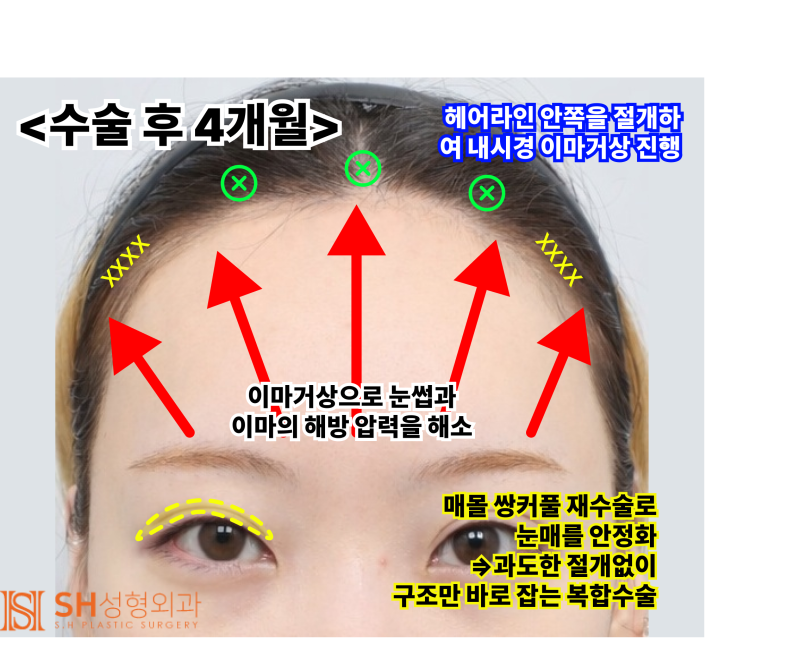 Endoscopic Forehead Lift and Revision Buried Suture Double Eyelid Surgery, Sub-brow Lift: Restoring Eye Structure at SH