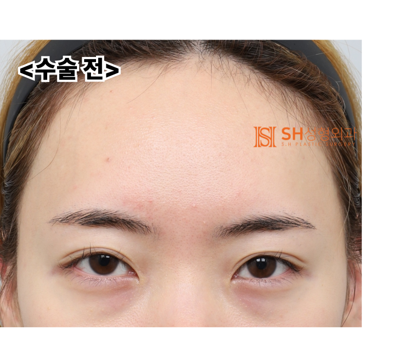 Endoscopic Forehead Lift and Revision Buried Suture Double Eyelid Surgery, Sub-brow Lift: Restoring Eye Structure at SH