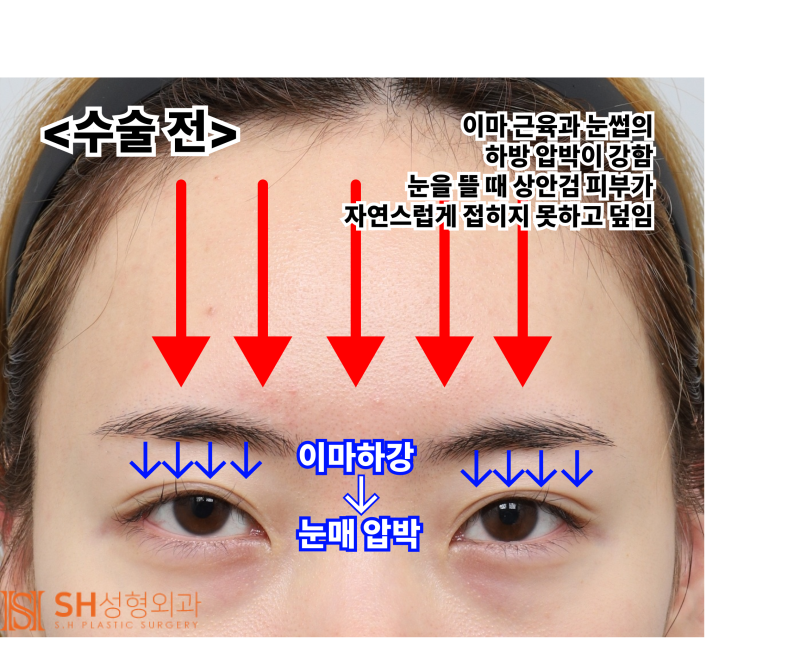Endoscopic Forehead Lift and Revision Buried Suture Double Eyelid Surgery, Sub-brow Lift: Restoring Eye Structure at SH