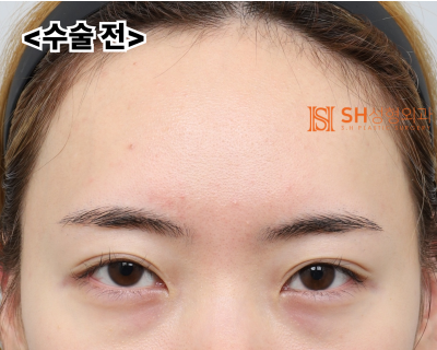Endoscopic Forehead Lift and Revision Buried Suture Double Eyelid Surgery, Sub-brow Lift: Restoring Eye Structure at SH