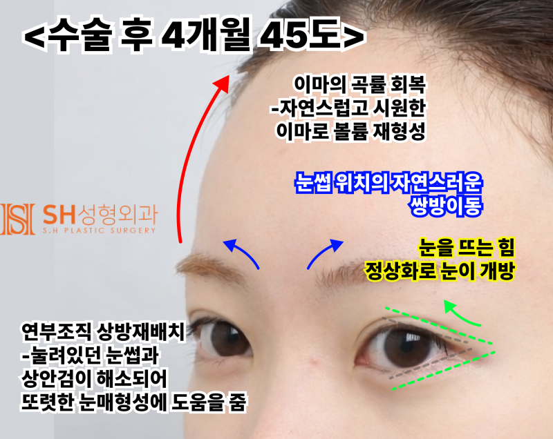 Endoscopic Forehead Lift and Revision Buried Suture Double Eyelid Surgery, Sub-brow Lift: Restoring Eye Structure at SH