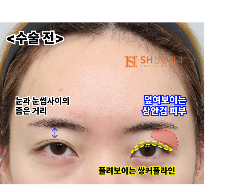 Endoscopic Forehead Lift and Revision Buried Suture Double Eyelid Surgery, Sub-brow Lift: Restoring Eye Structure at SH