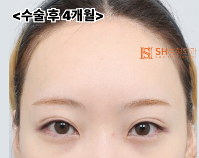 Endoscopic Forehead Lift and Revision Buried Suture Double Eyelid Surgery, Sub-brow Lift: Restoring Eye Structure at SH Plastic Surgery