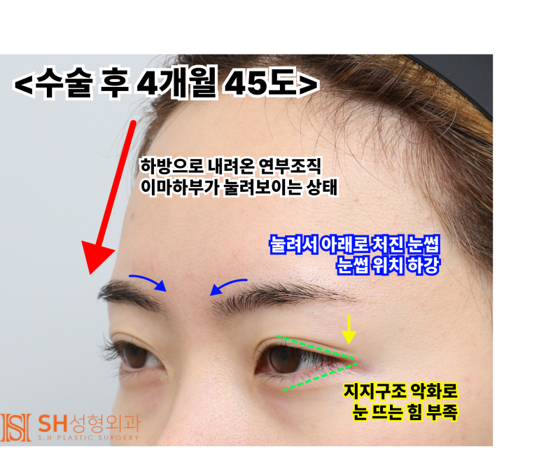 Endoscopic Forehead Lift and Revision Buried Suture Double Eyelid Surgery, Sub-brow Lift: Restoring Eye Structure at SH