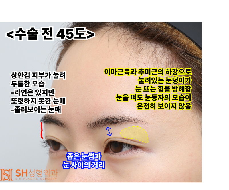 Endoscopic Forehead Lift and Revision Buried Suture Double Eyelid Surgery, Sub-brow Lift: Restoring Eye Structure at SH