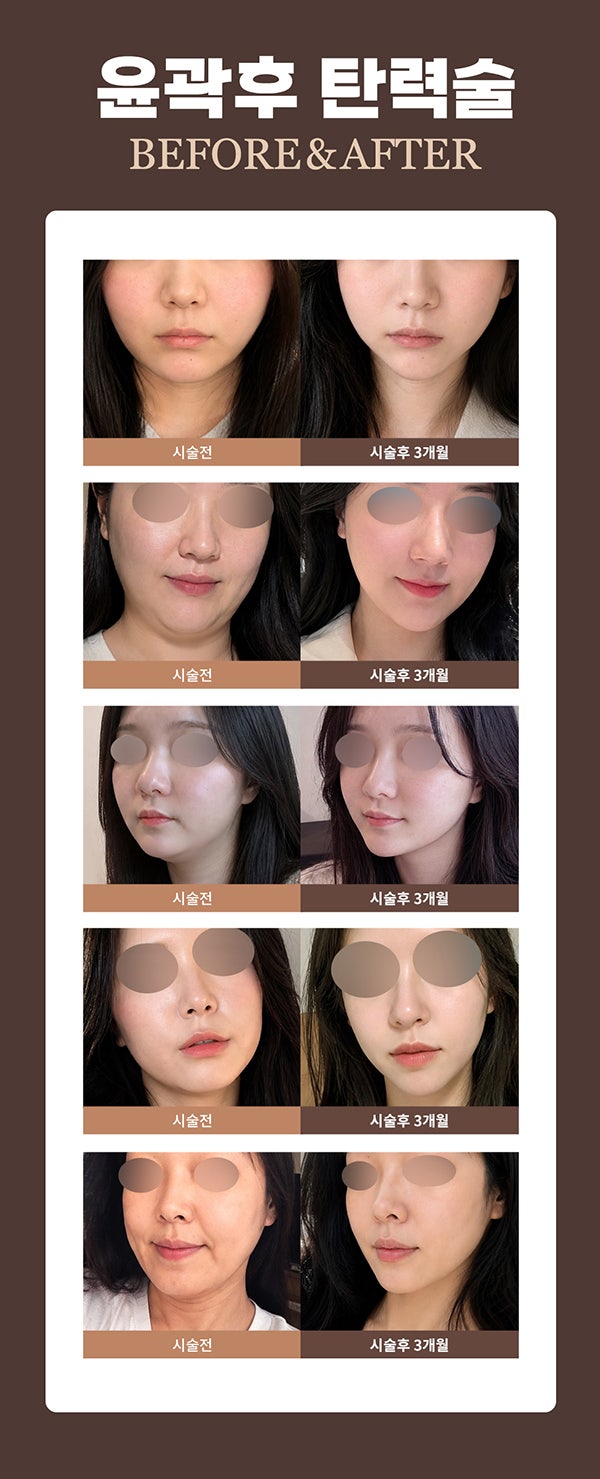 If You're Worried About Sagging Cheeks After Facial Contouring, Renewvion for Post-Contouring Care and Sagging Lifting!
