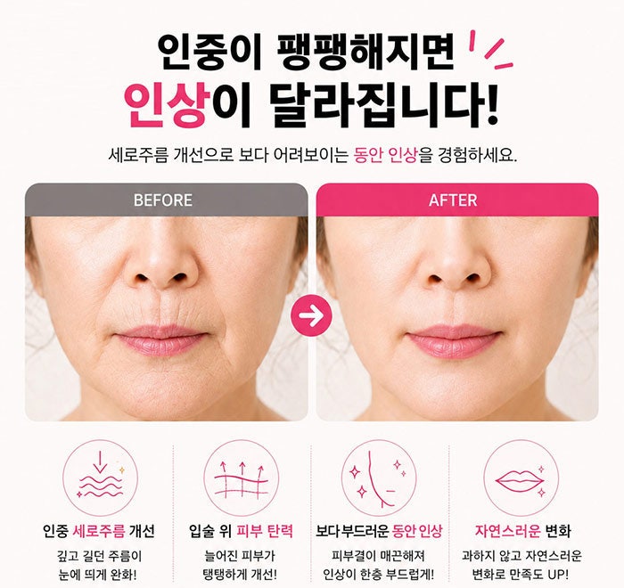 How to Get Rid of Vertical Philtrum Wrinkles! SH Plastic Surgery is Recruiting Models~ Click Here if You're Concerned About Your Philtrum!