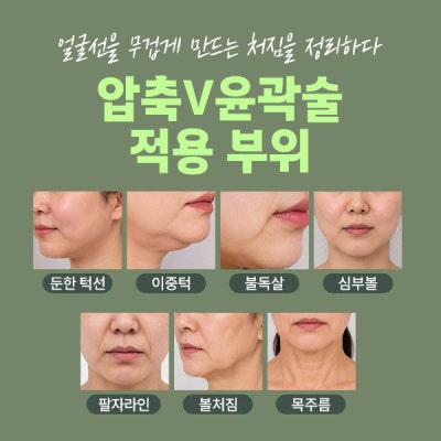 Renuvion Face Lifting (sh) SH Plastic Surgery Memberitahukan Facelift Non-Invasif~ 사진 12