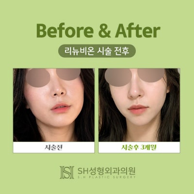 Renuvion Face Lifting (sh) SH Plastic Surgery Memberitahukan Facelift Non-Invasif~ 사진 3