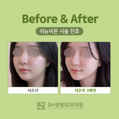 Renuvion Face Lifting (sh) SH Plastic Surgery Memberitahukan Facelift Non-Invasif~ 사진 4