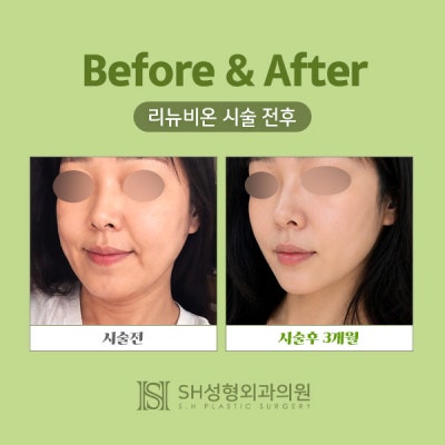 Renuvion Face Lifting (sh) SH Plastic Surgery Memberitahukan Facelift Non-Invasif~