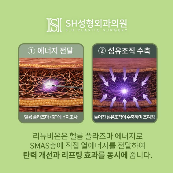 Renuvion Face Lifting (sh) SH Plastic Surgery Memberitahukan Facelift Non-Invasif~ 사진 10