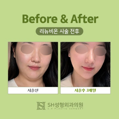Renuvion Face Lifting (sh) SH Plastic Surgery Memberitahukan Facelift Non-Invasif~ 사진 2