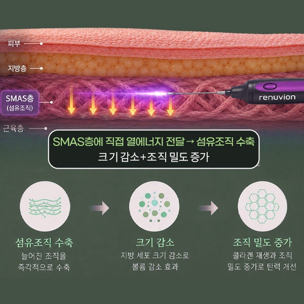 Renuvion Face Lifting (sh) SH Plastic Surgery Memberitahukan Facelift Non-Invasif~ 사진 11