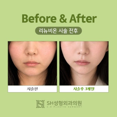 Renuvion Face Lifting (sh) SH Plastic Surgery Memberitahukan Facelift Non-Invasif~ 사진 5