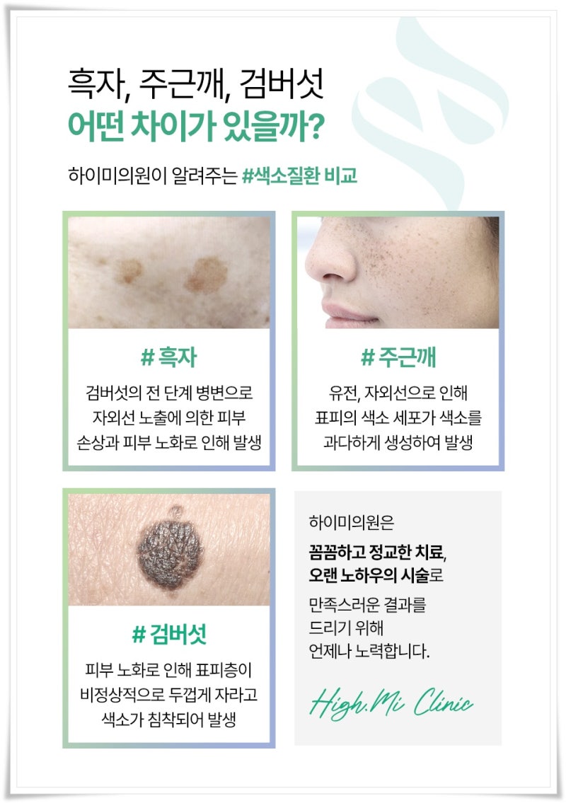 연산역검버섯 단순한 잡티로 넘기지 말아야 하는 이유 사진 3
