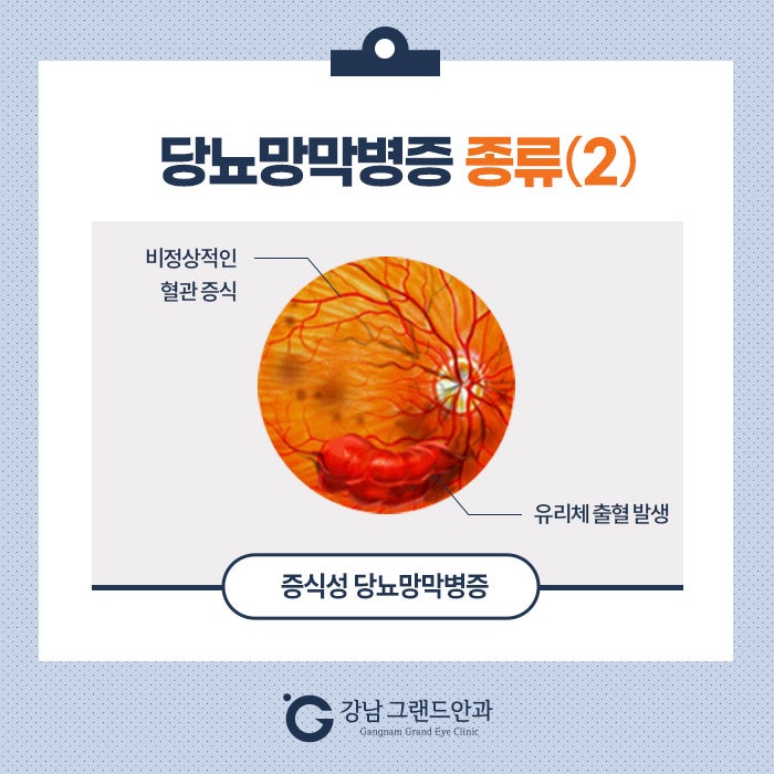 당뇨망막병증 증상 치료 중요성! 사진 3