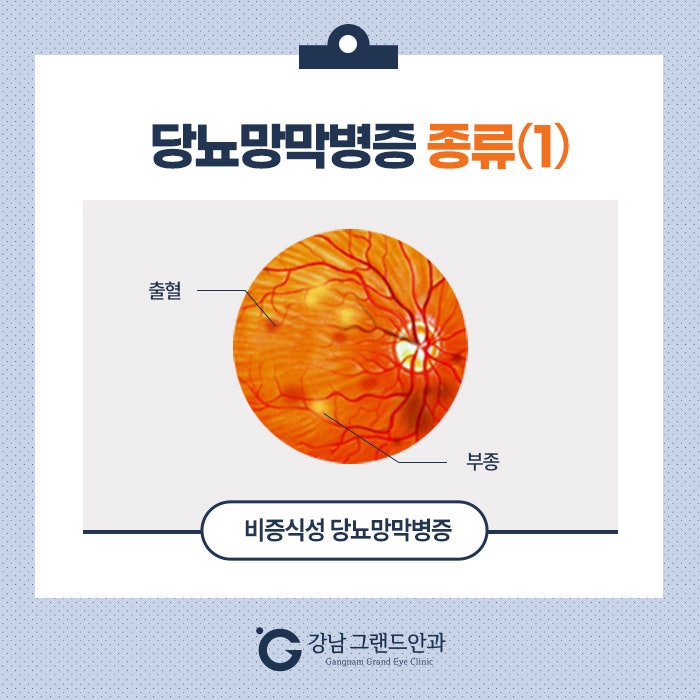 당뇨망막병증 증상 치료 중요성! 사진 2