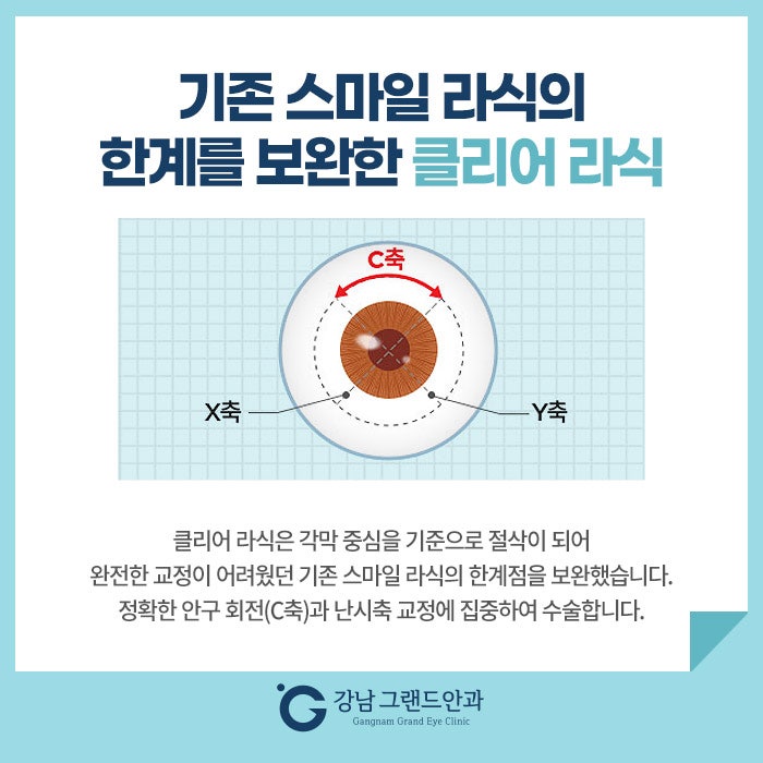라식라섹 수술 검사 왜 중요할까! 사진 4