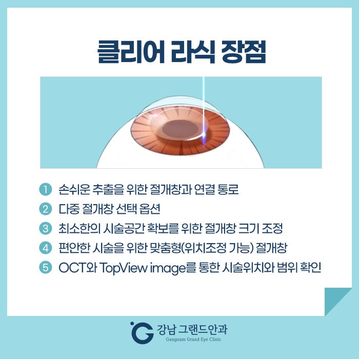 라식라섹 수술 검사 왜 중요할까! 사진 5